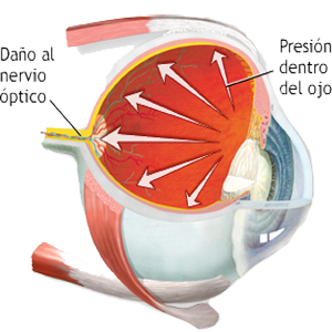 Ojo Cuerpo Vitreo Presion Ocular PIO Nervio Optico Daño